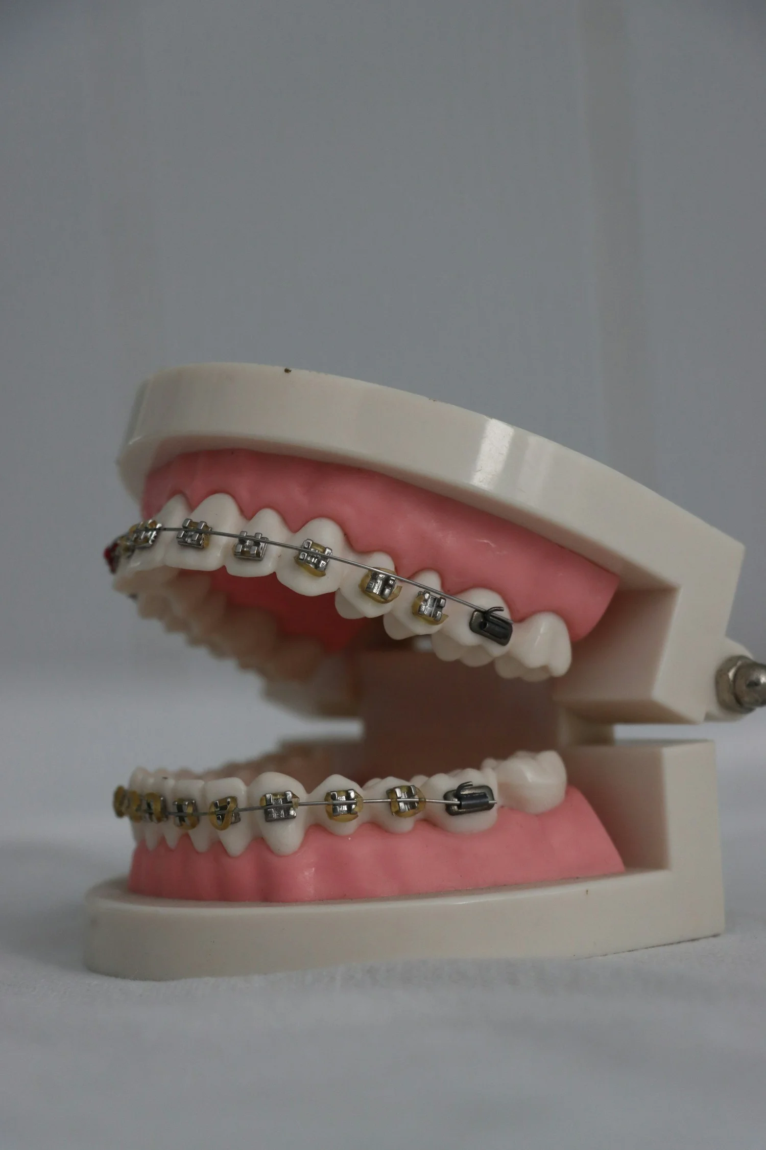 Close-up of orthodontic braces on teeth