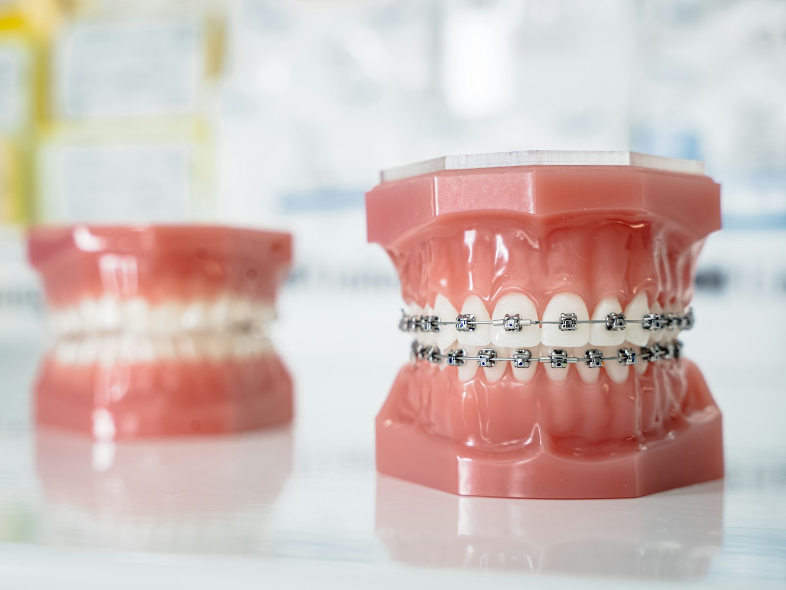 Dental model fitted with metal braces, showing brackets along the gum line during orthodontic treatment
