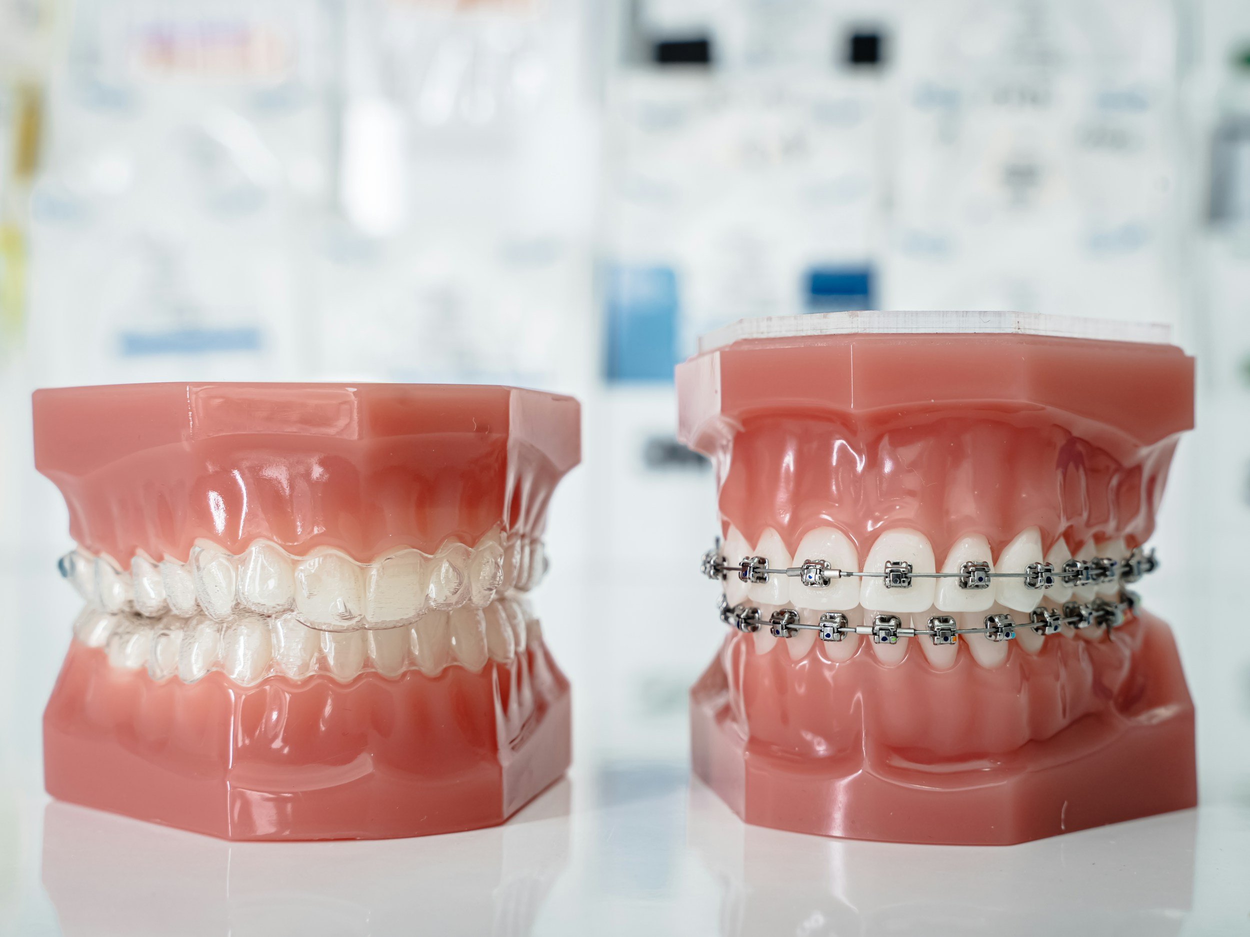 Different Types of Braces: Which Option Is Right for You?
