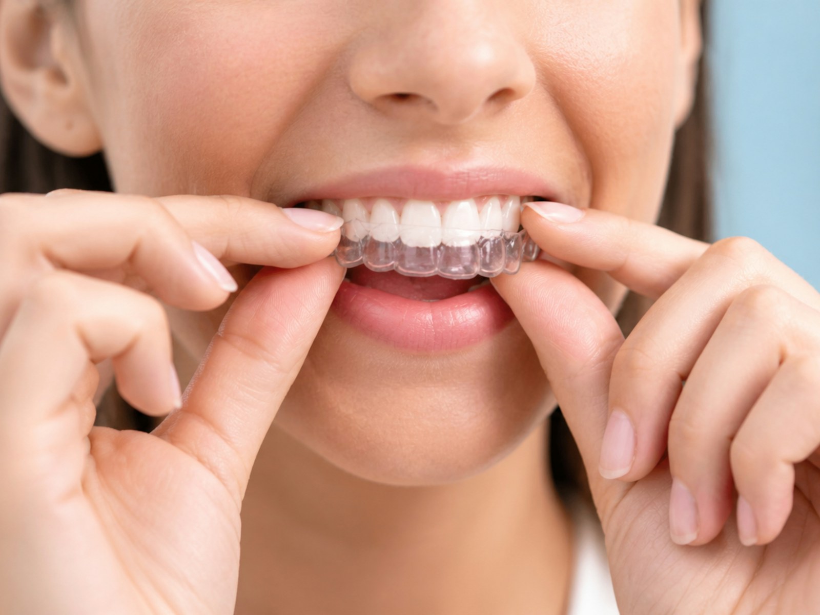 Woman placing a clear removable retainer over her top teeth