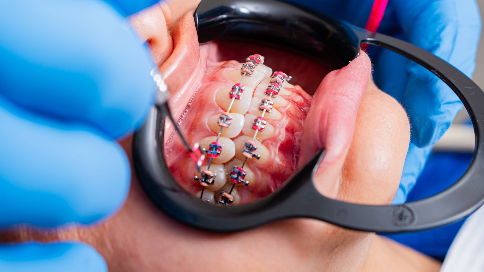 Close-up of metal braces with brackets and archwire during an orthodontic visit