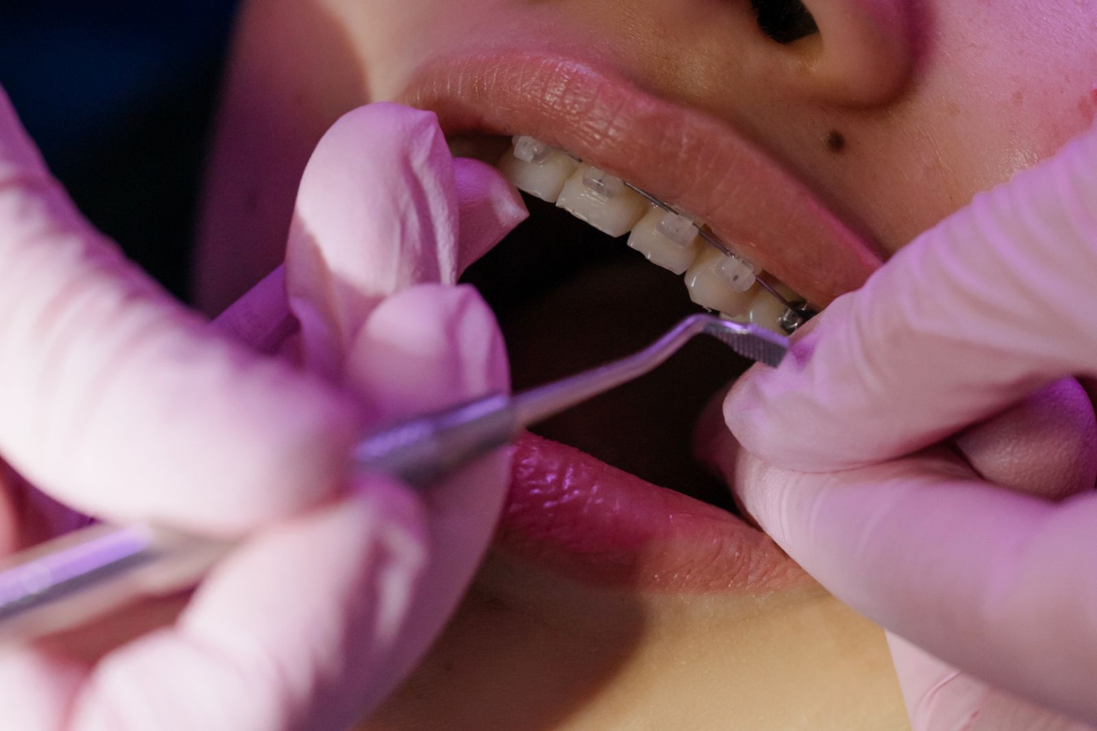 Orthodontist examining braces near the gum line with a dental tool