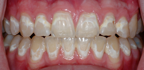Close-up of upper and lower front teeth showing chalky white spot lesions around where orthodontic brackets were bonded.