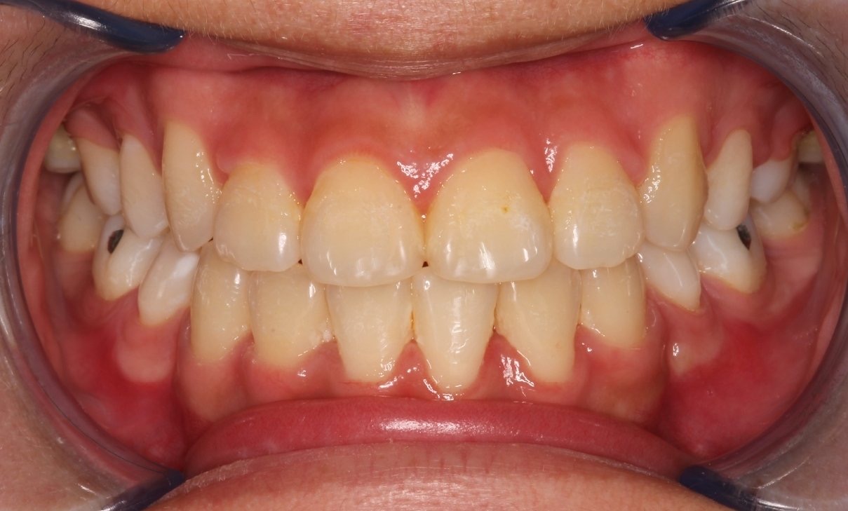 矯正後：牙齒整齊、咬合協調。 (After treatment: a close-up showing teeth aligned with a balanced bite.)