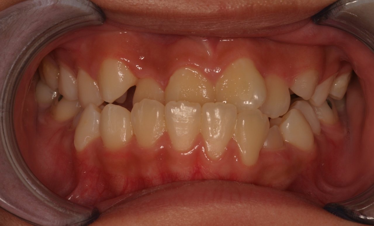 矯正前：牙齒擁擠、排列不齊。 (Before treatment: a close-up showing crowded and misaligned teeth.)