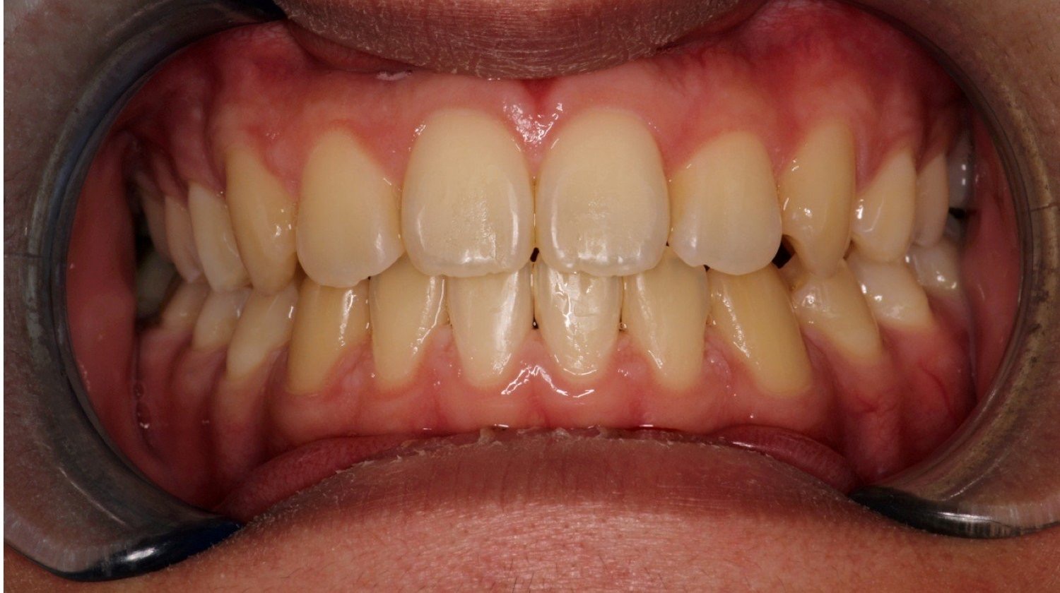 矯正後：牙齒排列整齊，使用牙科撐口器展示效果。 (After treatment: a close-up showing teeth aligned, held open with a dental retractor.)