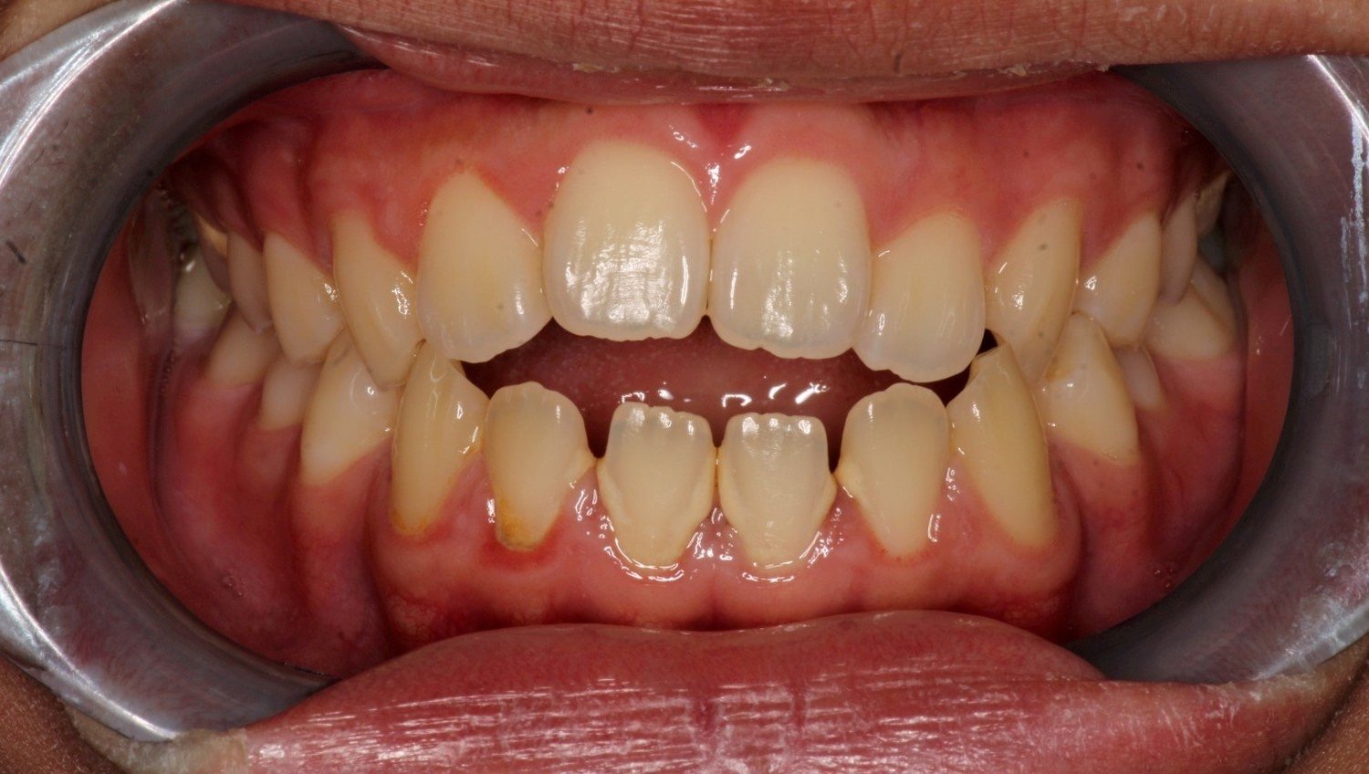 矯正前：牙齒擁擠及變色，使用牙科撐口器固定。 (Before treatment: a close-up showing teeth with crowding and discoloration, held open with a dental retractor.)