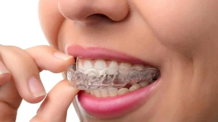 Retainers at Nexus Orthodontics