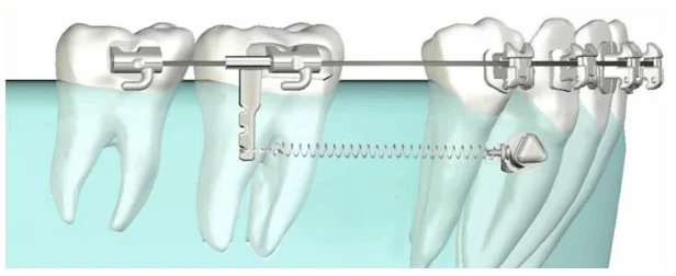 Temporary anchorage device illustration